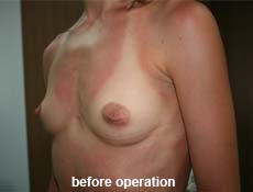 plastic-surgery-breast-augmentation 